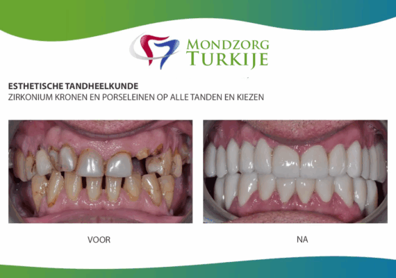 10-zirkonium-kronen-voortanden-en-porseleinen-kronen-kiesposities-2