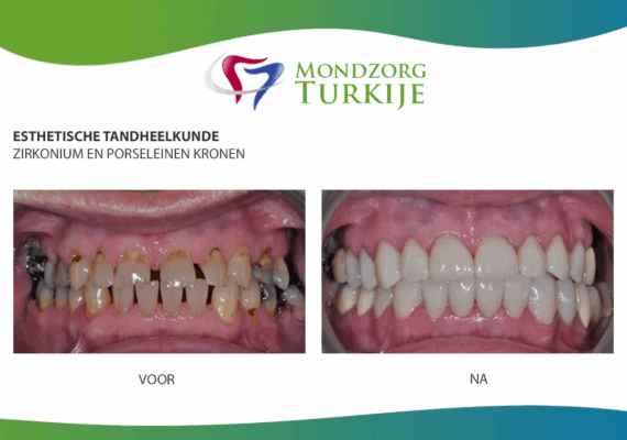22-gebitsrenovatie-zirkonium-kronen-1
